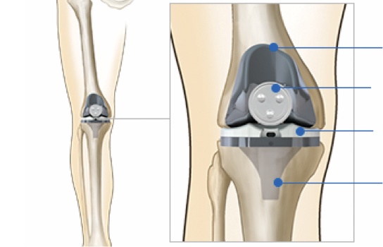 Total Knee Replacement Surgery